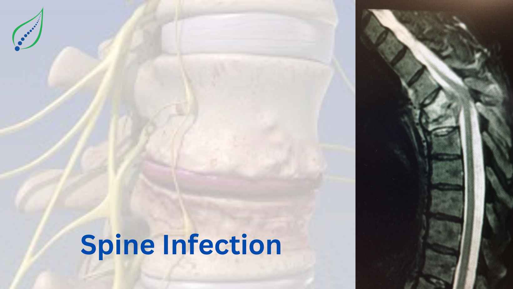 Spine Infection